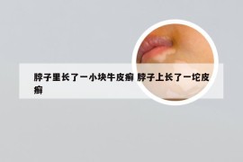 脖子里长了一小块牛皮癣 脖子上长了一坨皮癣