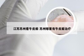 江苏苏州看牛皮癣 苏州哪里有牛皮廨治疗