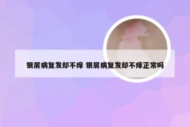 银屑病复发却不痒 银屑病复发却不痒正常吗
