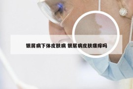 银屑病下体皮肤病 银屑病皮肤瘙痒吗
