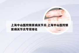 上海中山医院银屑病关节炎 上海中山医院银屑病关节炎专家排名