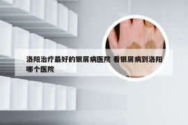 洛阳治疗最好的银屑病医院 看银屑病到洛阳哪个医院