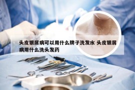 头皮银屑病可以用什么牌子洗发水 头皮银屑病用什么洗头发药