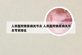 人民医院银屑病关节炎 人民医院银屑病关节炎专家排名