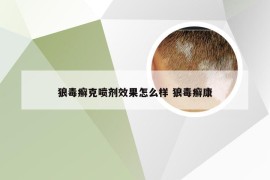 狼毒癣克喷剂效果怎么样 狼毒癣康