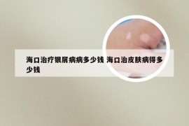 海口治疗银屑病病多少钱 海口治皮肤病得多少钱