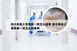 孩子身体上有像癣一斑怎么回事 孩子身体上有像癣一斑怎么回事啊