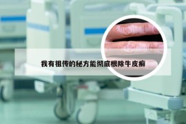 我有祖传的秘方能彻底根除牛皮癣