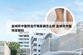 盐城市中医院治疗银屑病怎么样 盐城市中医院皮肤科