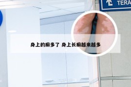 身上的癣多了 身上长癣越来越多