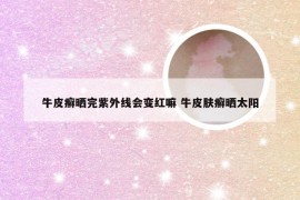 牛皮癣晒完紫外线会变红嘛 牛皮肤癣晒太阳