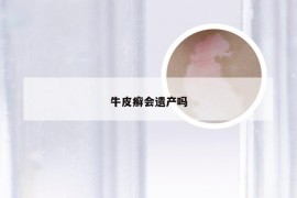 牛皮癣会遗产吗