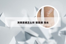 海银屑病怎么样 银屑病 海水