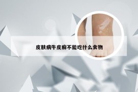 皮肤病牛皮癣不能吃什么食物