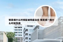 银屑病什么时候能被彻底治愈 银屑病一般什么时候发病