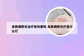 皮肤病照光治疗有效果吗 皮肤病照光疗是什么灯