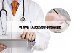 有没有什么皮肤病跟牛皮癣相似
