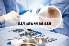 患上牛皮癣会有哪些症状出现