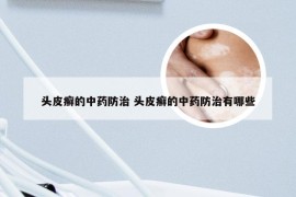 头皮癣的中药防治 头皮癣的中药防治有哪些