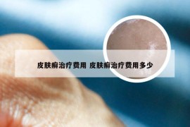 皮肤癣治疗费用 皮肤癣治疗费用多少