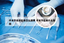 手关节皮肤起癣怎么回事 手关节起癣什么原因