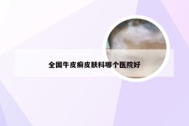 全国牛皮癣皮肤科哪个医院好