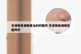天津银屑病哪里治的好医院 天津银屑病哪家医院好