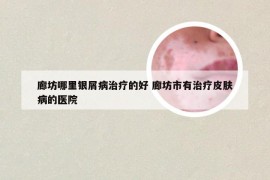 廊坊哪里银屑病治疗的好 廊坊市有治疗皮肤病的医院