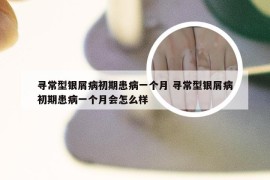 寻常型银屑病初期患病一个月 寻常型银屑病初期患病一个月会怎么样