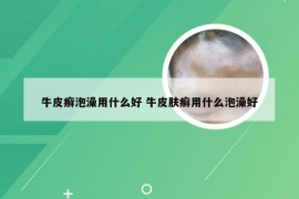 牛皮癣泡澡用什么好 牛皮肤癣用什么泡澡好