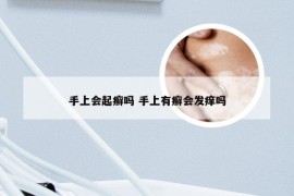 手上会起癣吗 手上有癣会发痒吗