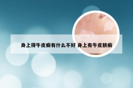 身上得牛皮癣有什么不好 身上有牛皮肤癣