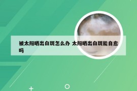 被太阳晒出白斑怎么办 太阳晒出白斑能自愈吗