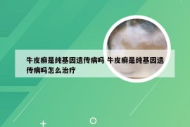 牛皮癣是纯基因遗传病吗 牛皮癣是纯基因遗传病吗怎么治疗