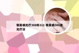 银屑病光疗308和311 银屑病308激光疗法