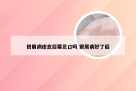 银屑病痊愈后要忌口吗 银屑病好了后