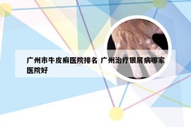 广州市牛皮癣医院排名 广州治疗银屑病哪家医院好