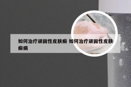 如何治疗顽固性皮肤癣 如何治疗顽固性皮肤癣病