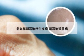 怎么样割耳治疗牛皮癣 割耳治银屑病