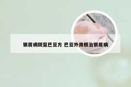 银屑病斑蝥巴豆方 巴豆外用根治银屑病