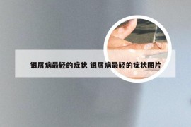 银屑病最轻的症状 银屑病最轻的症状图片