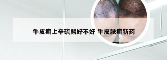 牛皮癣上辛硫麟好不好 牛皮肤癣新药