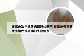 石家庄治疗银屑病最好的医院 石家庄哪家医院有治疗银屑病的生物制剂