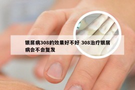 银屑病308的效果好不好 308治疗银屑病会不会复发