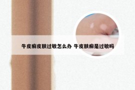 牛皮癣皮肤过敏怎么办 牛皮肤癣是过敏吗