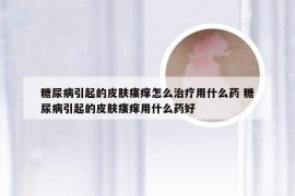 糖尿病引起的皮肤瘙痒怎么治疗用什么药 糖尿病引起的皮肤瘙痒用什么药好