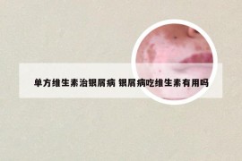 单方维生素治银屑病 银屑病吃维生素有用吗