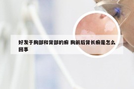 好发于胸部和背部的癣 胸前后背长癣是怎么回事