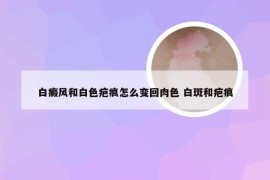 白癜风和白色疤痕怎么变回肉色 白斑和疤痕