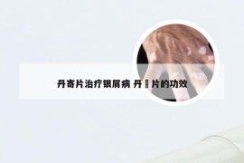丹寄片治疗银屑病 丹槮片的功效